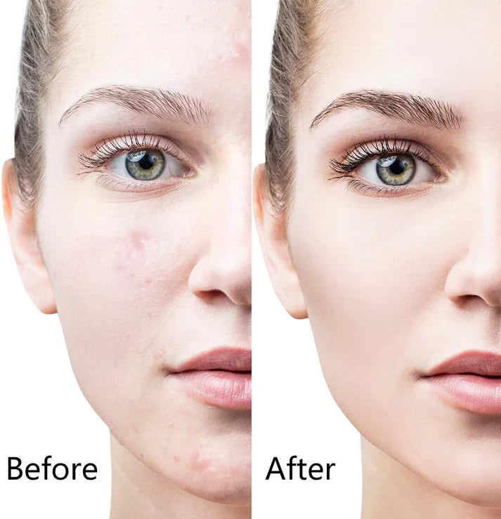 6-in-1 Microneedling Derma Roller Kit